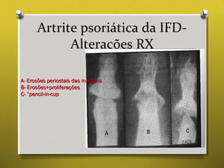 Artrite psoriática da IFD-
Alterações RX
A- Erosões periostais das margensA- Erosões periostais das margens
B- Erosões+proliferaçõesB- Erosões+proliferações
C- “pencil-in-cupC- “pencil-in-cup
 