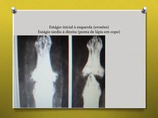 Estágio inicial à esquerda (erosões)
Estágio tardio à direita (ponta de lápis em copo)
 