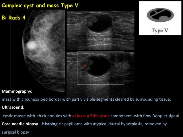 Jy Seror Breast Cyst Benign Or Malignant Jfim Hanoi 2015