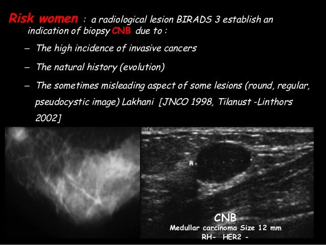 Metaplasic Carcinoma 4 Malignant Phyllodes Tumors Metaplasic Carcinoma 4 Malignant Phyllodes Tumors