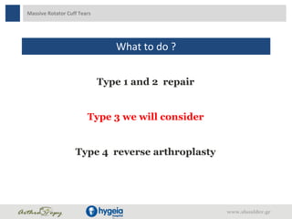 Massive Rotator Cuff Tears
What to do ?
Type 1 and 2 repair
Type 3 we will consider
Type 4 reverse arthroplasty
www.shoulder.gr
 