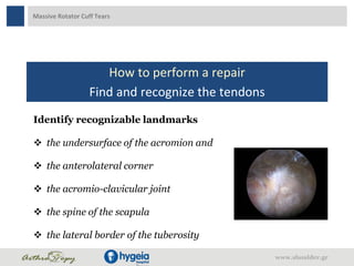 Massive Rotator Cuff Tears
How to perform a repair
Find and recognize the tendons
Identify recognizable landmarks
 the undersurface of the acromion and
 the anterolateral corner
 the acromio-clavicular joint
 the spine of the scapula
 the lateral border of the tuberosity
www.shoulder.gr
 