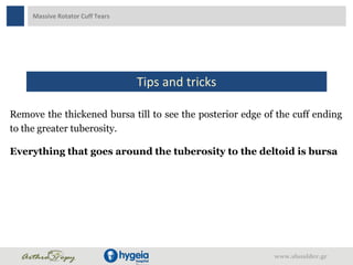 Massive Rotator Cuff Tears
Tips and tricks
Remove the thickened bursa till to see the posterior edge of the cuff ending
to the greater tuberosity.
Everything that goes around the tuberosity to the deltoid is bursa
www.shoulder.gr
 
