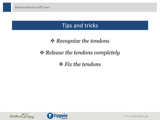 Massive Rotator Cuff Tears
Tips and tricks
 Recognize the tendons
 Release the tendons completely
 Fix the tendons
www.shoulder.gr
 