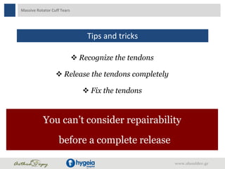 Massive Rotator Cuff Tears
Tips and tricks
 Recognize the tendons
 Release the tendons completely
 Fix the tendons
You can’t consider repairability
before a complete release
www.shoulder.gr
 