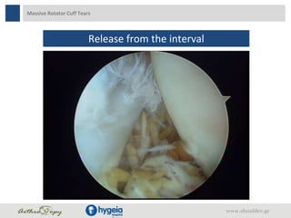 Massive Rotator Cuff Tears
www.shoulder.gr
Release from the interval
 