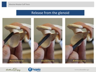 Massive Rotator Cuff Tears
Release from the glenoid
P o s t e r i o r l y S u p e r i o r l y A n t e r i o r l y
www.shoulder.gr
 