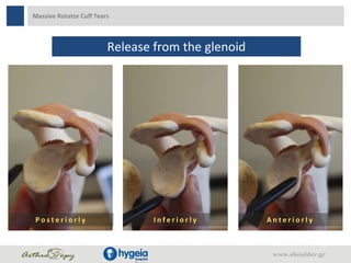 Massive Rotator Cuff Tears
Release from the glenoid
P o s t e r i o r l y I n f e r i o r l y A n t e r i o r l y
www.shoulder.gr
 