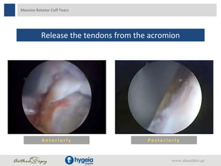 Massive Rotator Cuff Tears
Release the tendons from the acromion
P o s t e r i o r l yA n t e r i o r l y
www.shoulder.gr
 