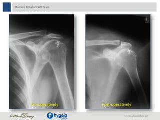 Massive Rotator Cuff Tears
Pre-operatively Post-operatively
www.shoulder.gr
 