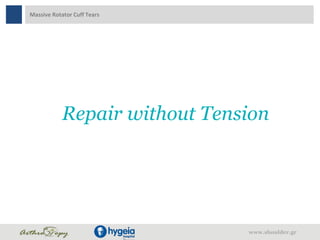 Massive Rotator Cuff Tears
www.shoulder.gr
Repair without Tension
 