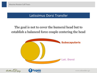 Massive Rotator Cuff Tears
Latissimus Dorsi Transfer
www.shoulder.gr
The goal is not to cover the humeral head but to
establish a balanced force couple centering the head
Subscapularis
Lat. Dorsi
 