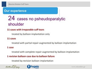 11 cases with irreparable cuff tears
treated by balloon implantation only
11 cases
treated with partial repair augmented by balloon implantation
1 case
treated with complete repair augmented by balloon implantation
1 revision balloon case due to balloon failure
treated by revision balloon implantation
Our experience
24 cases no psheudoparalytic
shoulder
Massive Rotator Cuff Tears
www.shoulder.gr
 
