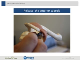 Massive Rotator Cuff Tears
Release the anterior capsule
www.shoulder.gr
 