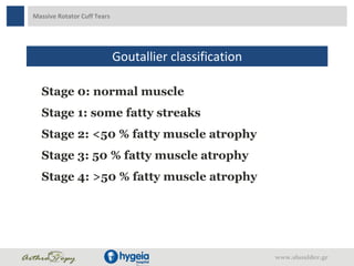Massive Rotator Cuff Tears
Goutallier classification
Stage 0: normal muscle
Stage 1: some fatty streaks
Stage 2: <50 % fatty muscle atrophy
Stage 3: 50 % fatty muscle atrophy
Stage 4: >50 % fatty muscle atrophy
www.shoulder.gr
 