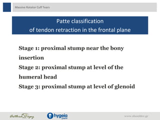 Massive Rotator Cuff Tears
Patte classification
of tendon retraction in the frontal plane
Stage 1: proximal stump near the bony
insertion
Stage 2: proximal stump at level of the
humeral head
Stage 3: proximal stump at level of glenoid
www.shoulder.gr
 
