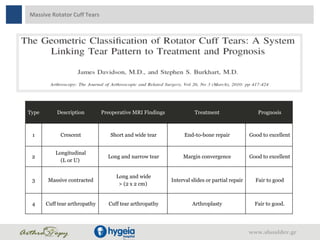 Massive Rotator Cuff Tears
Type Description Preoperative MRI Findings Treatment Prognosis
1 Crescent Short and wide tear End-to-bone repair Good to excellent
2
Longitudinal
(L or U)
Long and narrow tear Margin convergence Good to excellent
3 Massive contracted
Long and wide
> (2 x 2 cm)
Interval slides or partial repair Fair to good
4 Cuff tear arthropathy Cuff tear arthropathy Arthroplasty Fair to good.
www.shoulder.gr
 