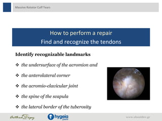 Massive Rotator Cuff Tears
How to perform a repair
Find and recognize the tendons
Identify recognizable landmarks
 the un...