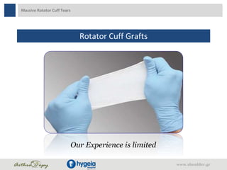 Massive Rotator Cuff Tears
Rotator Cuff Grafts
www.shoulder.gr
Our Experience is limited
 