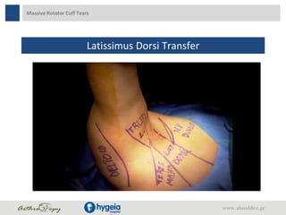 Massive Rotator Cuff Tears
Latissimus Dorsi Transfer
www.shoulder.gr
 
