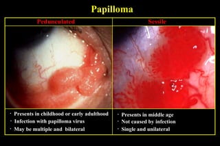 conjunctival papilloma treatment