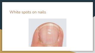 White spots on nails
 