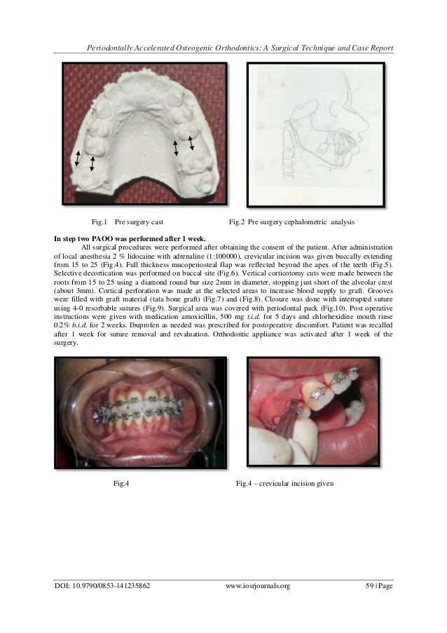 Periodontally Accelerated Osteogenic Orthodontics A Surgical Techniq…