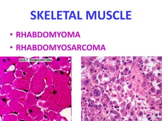 SKELETAL MUSCLE
• RHABDOMYOMA
• RHABDOMYOSARCOMA
 