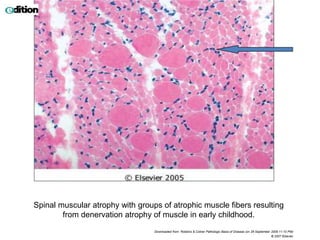 Spinal muscular atrophy with groups of atrophic muscle fibers resulting
from denervation atrophy of muscle in early childhood.
Downloaded from: Robbins & Cotran Pathologic Basis of Disease (on 28 September 2009 11:10 PM)
© 2007 Elsevier
 