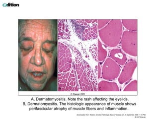 A, Dermatomyositis. Note the rash affecting the eyelids.
B, Dermatomyositis. The histologic appearance of muscle shows
perifascicular atrophy of muscle fibers and inflammation..
Downloaded from: Robbins & Cotran Pathologic Basis of Disease (on 28 September 2009 11:10 PM)
© 2007 Elsevier
 