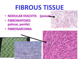 FIBROUS TISSUE
• NODULAR FASCIITIS (pseudosarcomatous)
• FIBROMATOSES (plantar,
palmar, penile)
• FIBROSARCOMA
 