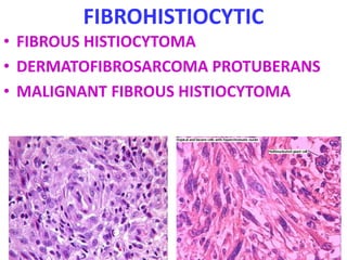 FIBROHISTIOCYTIC
• FIBROUS HISTIOCYTOMA
• DERMATOFIBROSARCOMA PROTUBERANS
• MALIGNANT FIBROUS HISTIOCYTOMA
 