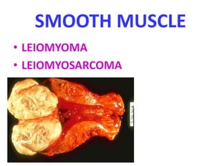 SMOOTH MUSCLE
• LEIOMYOMA
• LEIOMYOSARCOMA
 