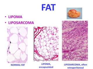 FAT
• LIPOMA
• LIPOSARCOMA
NORMAL FAT LIPOMA,
encapsulated
LIPOSARCOMA, often
retroperitoneal
 