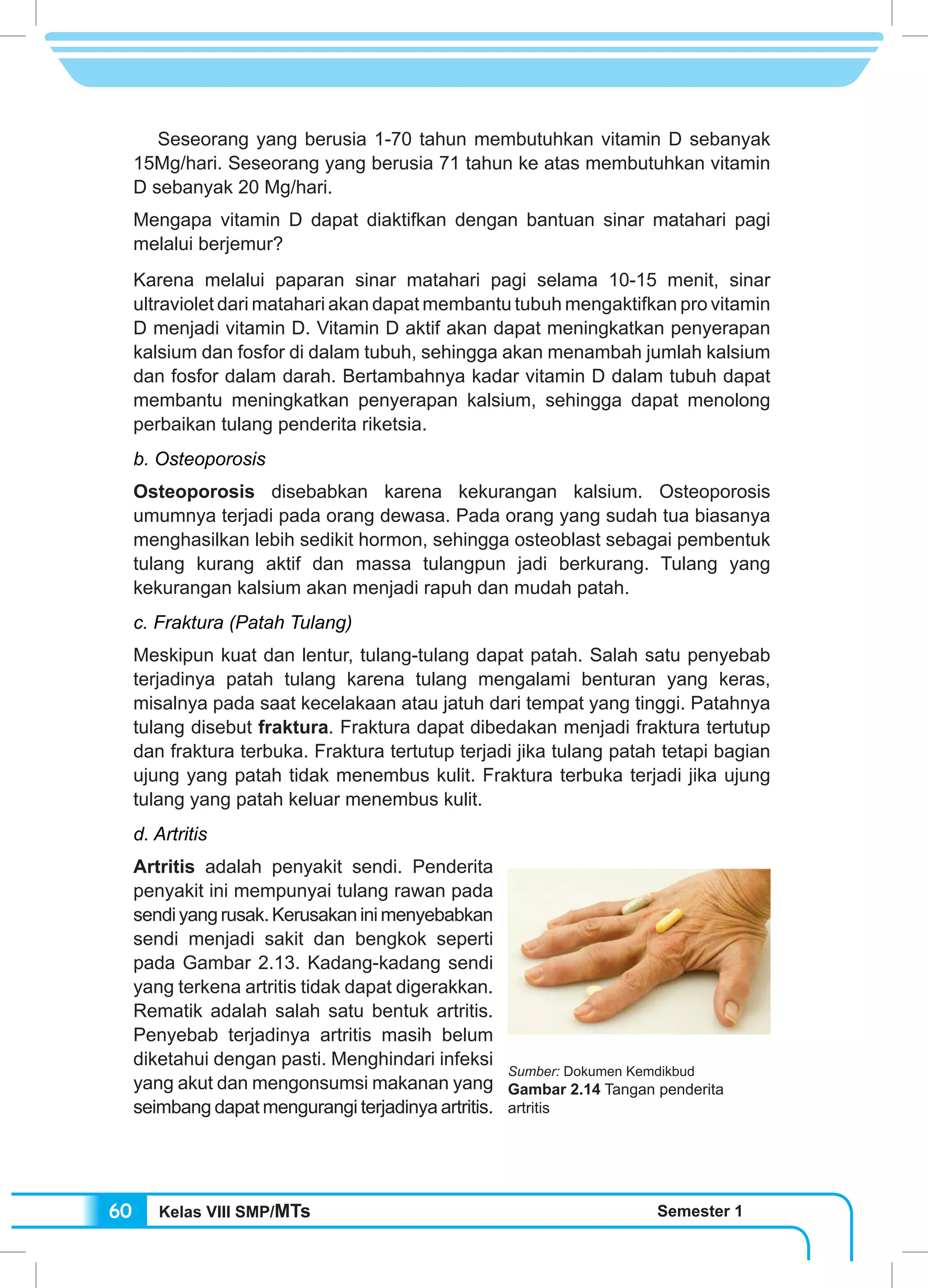 Kelas VIII SMP/MTs Semester 160
Seseorang yang berusia 1-70 tahun membutuhkan vitamin D sebanyak
15Mg/hari. Seseorang yang berusia 71 tahun ke atas membutuhkan vitamin
D sebanyak 20 Mg/hari.
Mengapa vitamin D dapat diaktifkan dengan bantuan sinar matahari pagi
melalui berjemur?
Karena melalui paparan sinar matahari pagi selama 10-15 menit, sinar
ultraviolet dari matahari akan dapat membantu tubuh mengaktifkan pro vitamin
D menjadi vitamin D. Vitamin D aktif akan dapat meningkatkan penyerapan
kalsium dan fosfor di dalam tubuh, sehingga akan menambah jumlah kalsium
dan fosfor dalam darah. Bertambahnya kadar vitamin D dalam tubuh dapat
membantu meningkatkan penyerapan kalsium, sehingga dapat menolong
perbaikan tulang penderita riketsia.
b. Osteoporosis
Osteoporosis disebabkan karena kekurangan kalsium. Osteoporosis
umumnya terjadi pada orang dewasa. Pada orang yang sudah tua biasanya
menghasilkan lebih sedikit hormon, sehingga osteoblast sebagai pembentuk
tulang kurang aktif dan massa tulangpun jadi berkurang. Tulang yang
kekurangan kalsium akan menjadi rapuh dan mudah patah.
c. Fraktura (Patah Tulang)
Meskipun kuat dan lentur, tulang-tulang dapat patah. Salah satu penyebab
terjadinya patah tulang karena tulang mengalami benturan yang keras,
misalnya pada saat kecelakaan atau jatuh dari tempat yang tinggi. Patahnya
tulang disebut fraktura. Fraktura dapat dibedakan menjadi fraktura tertutup
dan fraktura terbuka. Fraktura tertutup terjadi jika tulang patah tetapi bagian
ujung yang patah tidak menembus kulit. Fraktura terbuka terjadi jika ujung
tulang yang patah keluar menembus kulit.
d. Artritis
Artritis adalah penyakit sendi. Penderita
penyakit ini mempunyai tulang rawan pada
sendiyangrusak.Kerusakaninimenyebabkan
sendi menjadi sakit dan bengkok seperti
pada Gambar 2.13. Kadang-kadang sendi
yang terkena artritis tidak dapat digerakkan.
Rematik adalah salah satu bentuk artritis.
Penyebab terjadinya artritis masih belum
diketahui dengan pasti. Menghindari infeksi
yang akut dan mengonsumsi makanan yang
seimbang dapat mengurangi terjadinya artritis.
Sumber: Dokumen Kemdikbud
Gambar 2.14 Tangan penderita
artritis
 