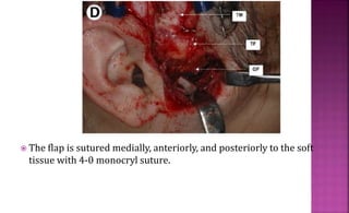 The flap is sutured medially, anteriorly, and posteriorly to the soft
tissue with 4-0 monocryl suture.
 