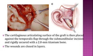  The cartilaginous articulating surface of the graft is then placed
against the temporalis flap through the submandibular incision
and rigidly secured with a 2.0-mm titanium bone.
 The wounds are closed in layers.
 