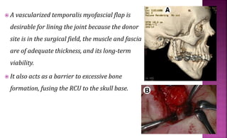  A vascularized temporalis myofascial flap is
desirable for lining the joint because the donor
site is in the surgical field, the muscle and fascia
are of adequate thickness, and its long-term
viability.
 It also acts as a barrier to excessive bone
formation, fusing the RCU to the skull base.
 
