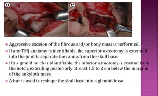  Aggressive excision of the fibrous and/or bony mass is performed.
 If any TMJ anatomy is identifiable, the superior osteotomy is extended
into the joint to separate the ramus from the skull base.
 If a sigmoid notch is identifiable, the inferior osteotomy is created from
the notch, extending posteriorly at least 1.5 to 2 cm below the margine
of the ankylotic mass.
 A bur is used to reshape the skull base into a glenoid fossa.
 