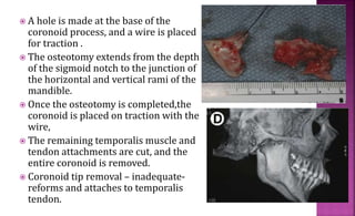  A hole is made at the base of the
coronoid process, and a wire is placed
for traction .
 The osteotomy extends from the depth
of the sigmoid notch to the junction of
the horizontal and vertical rami of the
mandible.
 Once the osteotomy is completed,the
coronoid is placed on traction with the
wire,
 The remaining temporalis muscle and
tendon attachments are cut, and the
entire coronoid is removed.
 Coronoid tip removal – inadequate-
reforms and attaches to temporalis
tendon.
 