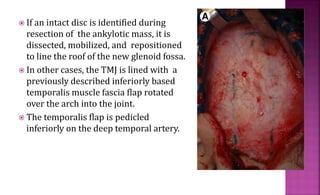  If an intact disc is identified during
resection of the ankylotic mass, it is
dissected, mobilized, and repositioned
to line the roof of the new glenoid fossa.
 In other cases, the TMJ is lined with a
previously described inferiorly based
temporalis muscle fascia flap rotated
over the arch into the joint.
 The temporalis flap is pedicled
inferiorly on the deep temporal artery.
 