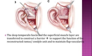  The deep temporalis fascia and the superficial muscle layer are
transferred to construct a barrier  to support the function of the
reconstructed ramus/ condyle unit and to maintain flap vascularity.
 
