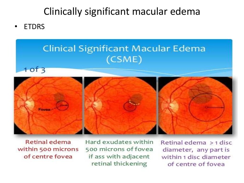 Diabetic Retinopathy (ophthalmology)