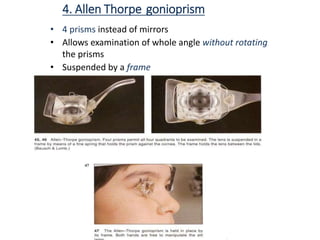 4. Allen Thorpe gonioprism
• 4 prisms instead of mirrors
• Allows examination of whole angle without rotating
the prisms
• Suspended by a frame
 