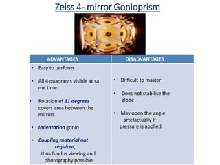 Zeiss 4- mirror Gonioprism
ADVANTAGES DISADVANTAGES
• Easy to perform
• All 4 quadrants visible at sa
me time
• Rotation of 11 degrees
covers area between the
mirrors
• Indentation gonio
• Coupling material not
required,
thus fundus viewing and
photography possible
• Difficult to master
• Does not stabilise the
globe
• May open the angle
artefactually If
pressure is applied
 