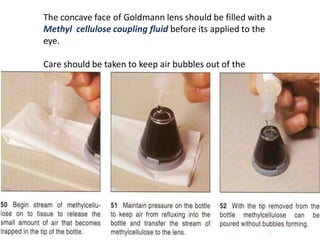 The concave face of Goldmann lens should be filled with a
Methyl cellulose coupling fluid before its applied to the
eye.
Care should be taken to keep air bubbles out of the
solution
 