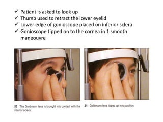  Patient is asked to look up
 Thumb used to retract the lower eyelid
 Lower edge of gonioscope placed on inferior sclera
 Gonioscope tipped on to the cornea in 1 smooth
maneouvre
 