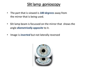 Slit lamp gonioscopy
• The part that is viewed is 180 degrees away from
the mirror that is being used.
• Slit lamp beam is focussed on the mirror that shows the
angle diametrically opposite to it.
• Image is inverted but not laterally reversed
 