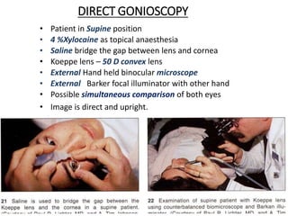 DIRECT GONIOSCOPY
• Patient in Supine position
• 4 %Xylocaine as topical anaesthesia
• Saline bridge the gap between lens and cornea
• Koeppe lens – 50 D convex lens
• External Hand held binocular microscope
• External Barker focal illuminator with other hand
• Possible simultaneous comparison of both eyes
• Image is direct and upright.
 