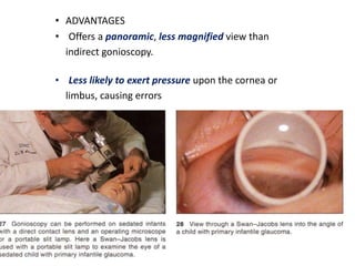 • ADVANTAGES
• Offers a panoramic, less magnified view than
indirect gonioscopy.
• Less likely to exert pressure upon the cornea or
limbus, causing errors
 